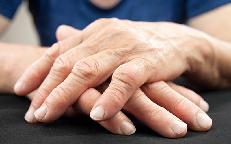 Image: Hands with Evidence of Rheumatoid Arthritis